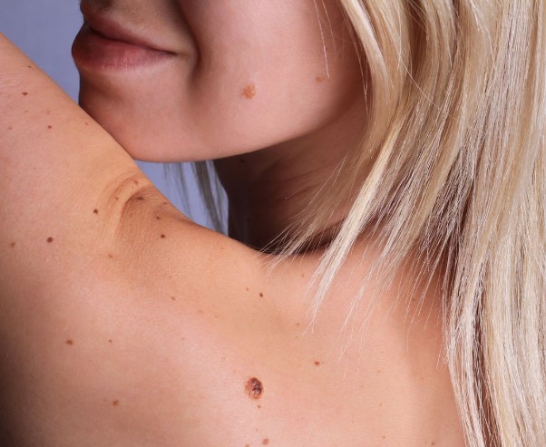 Rreziku i shtuar nga melanoma gjatë verës, kush rrezikon më shumë?