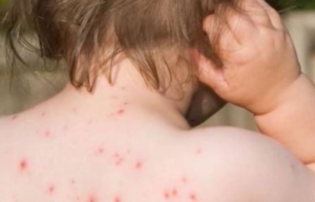 Alarmi nga fruthi, cilat janë qarqet ku mund të ketë shpërthime epidemike