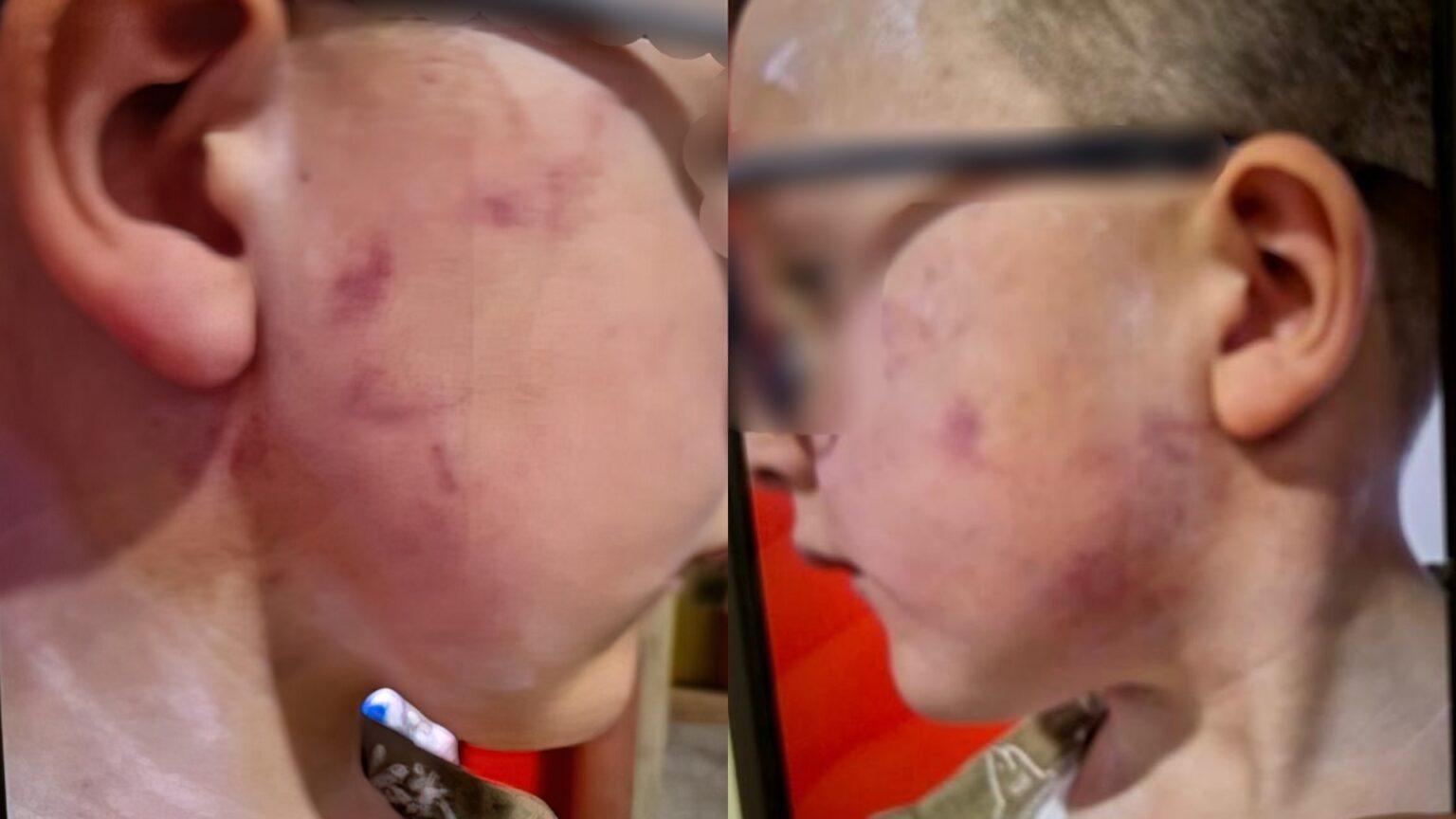 Nëna merr djalin nga kopshti “Gledis” me shenja e të nxira në fytyrë (DENONCIMI) 