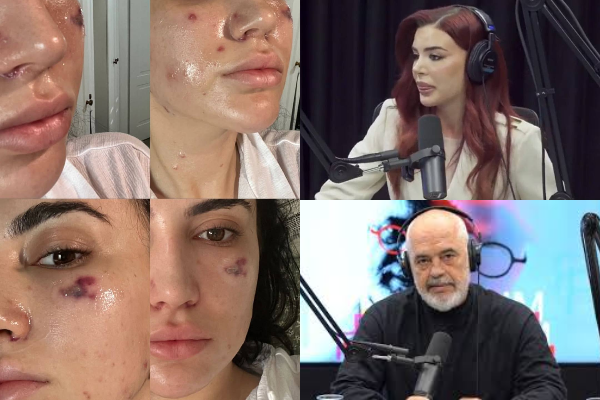 Doktoreshë Vilma Tafilaj që promovoi Rama masakroi gazetaren duke i djegur fytyrën