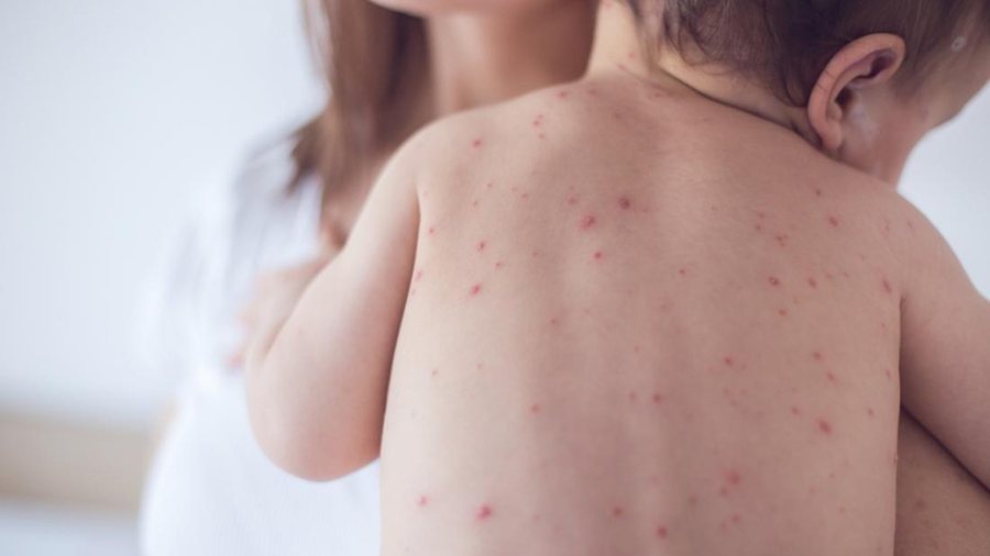 “Shpërthen” fruthi në kryeqytet, 15 të mitur të infektuar benda një kopshti