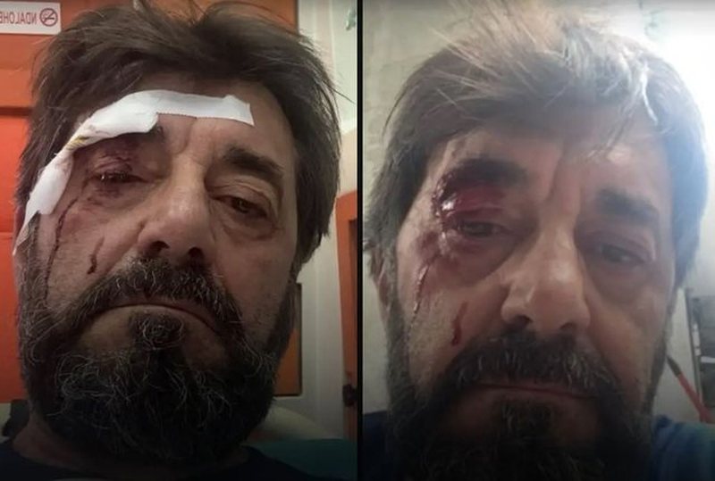 Dhunimi i Ilir Demaliajt, gazetari sqaron ngjarjen: Dy persona më goditën me grushte sa dola nga shtëpia, thanë se kisha lajmëruar policinë për…